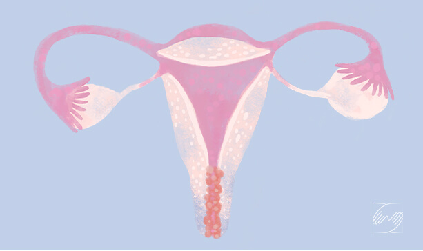 Imagem Câncer de colo uterino
